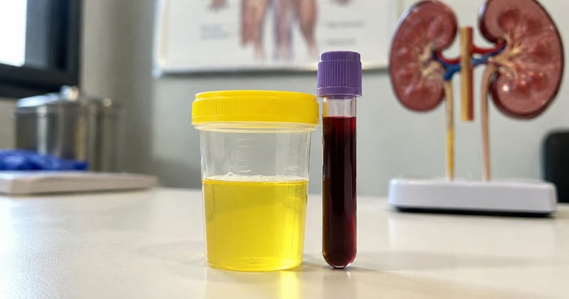 Saps realment com es detecta la malaltia renal crònica?
